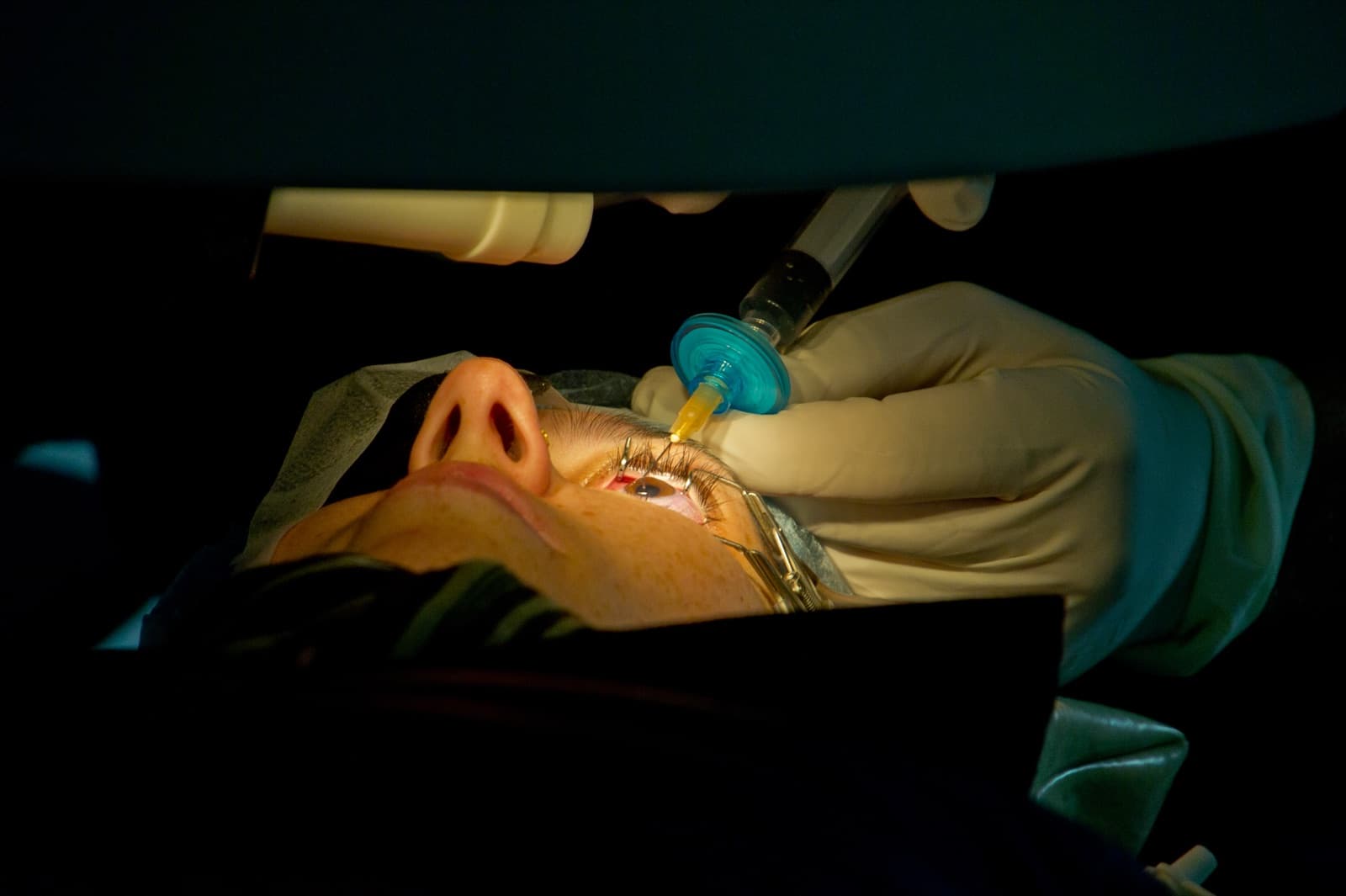 Contoura Vision (Topography-Guided LASIK)