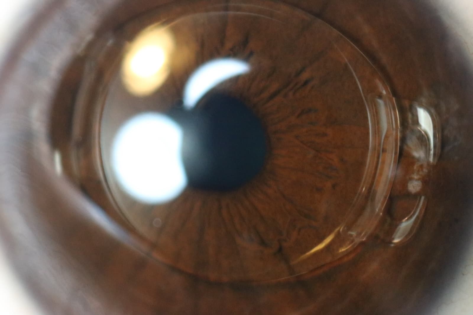 ICL (Implantable Collamer Lens) in Bandra West, Mumbai