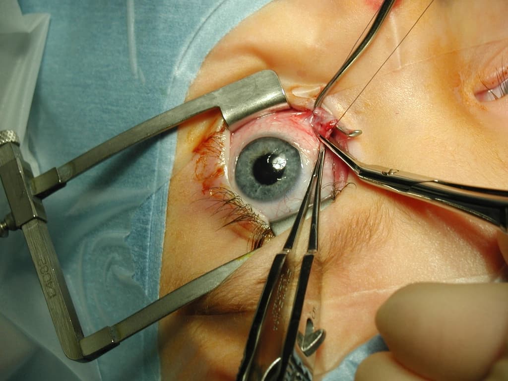 Oculoplasty / Eyelid & Orbit Surgery