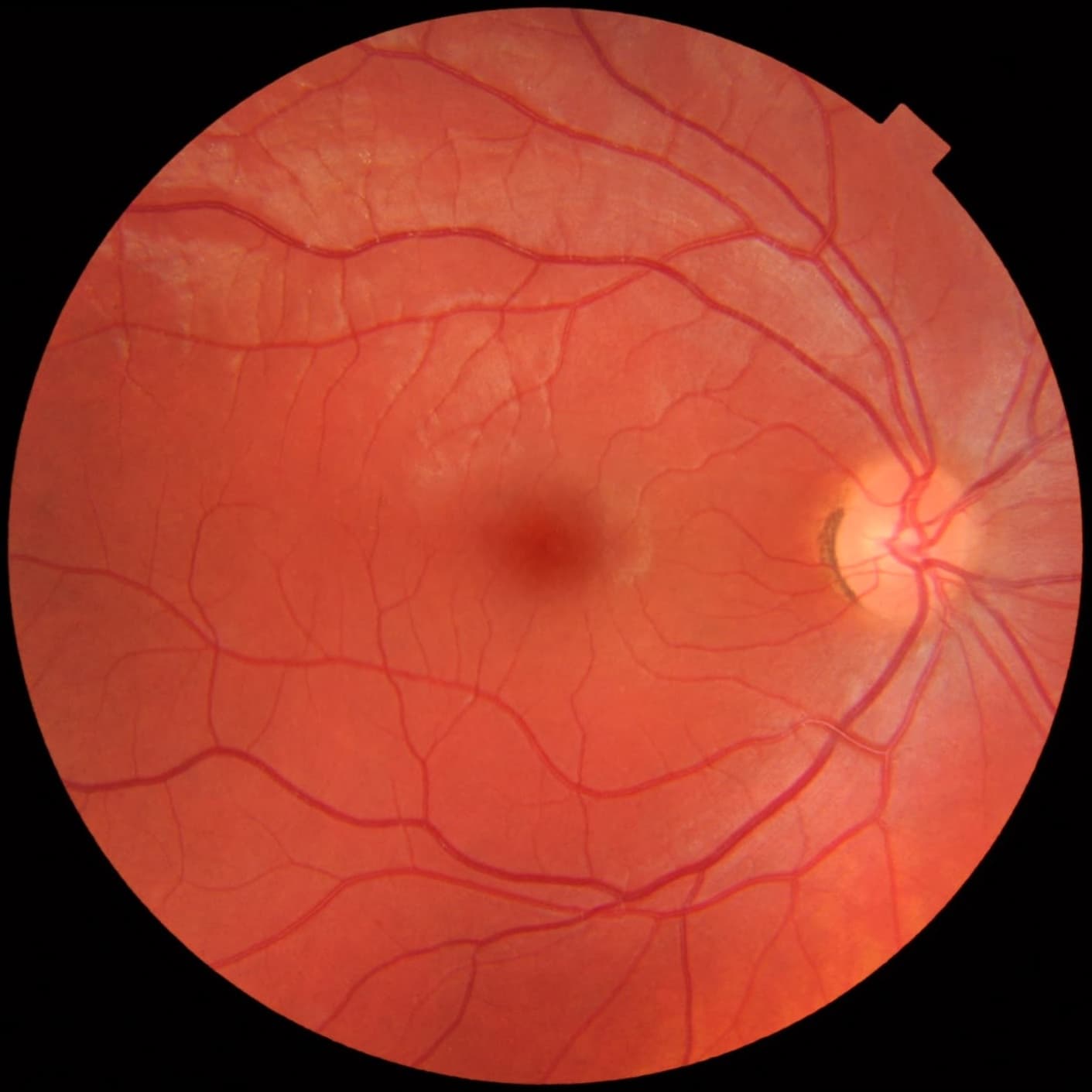 Retinal Laser Photocoagulation